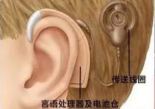 9个月宝宝佩戴人工耳蜗后因听到声音而哭泣